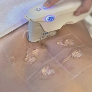 Ultrasonido microfocalizado por zona